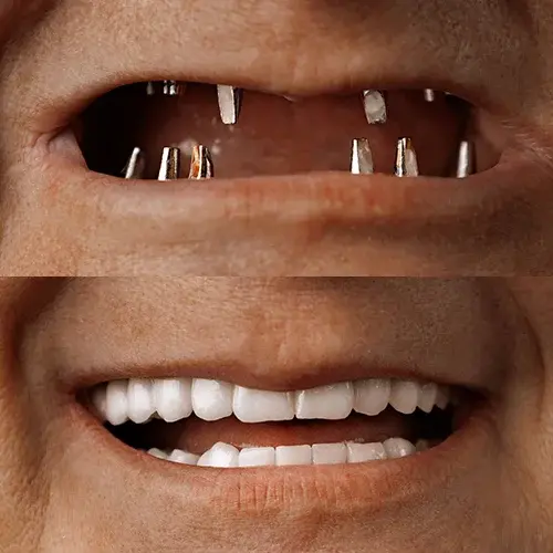 All On 6 Zirconium