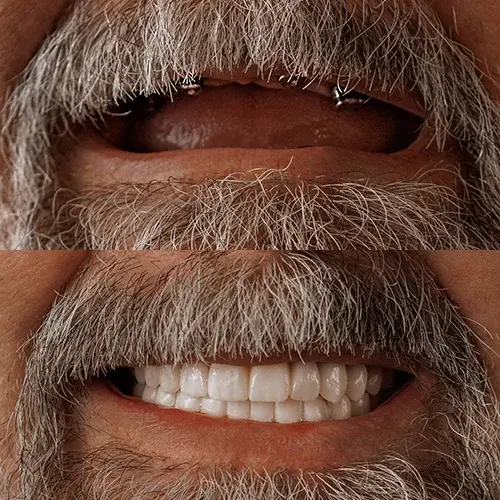 Dental Implant