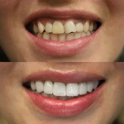 Full Mouth Zirconium