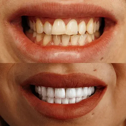 Full Mouth Zirconium