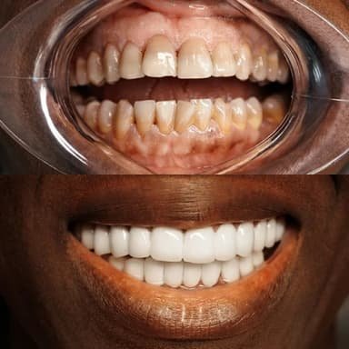 Full Mouth Zirconium