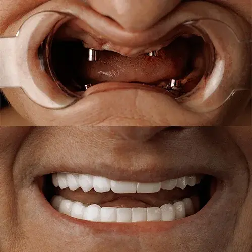 Zygoma Implant